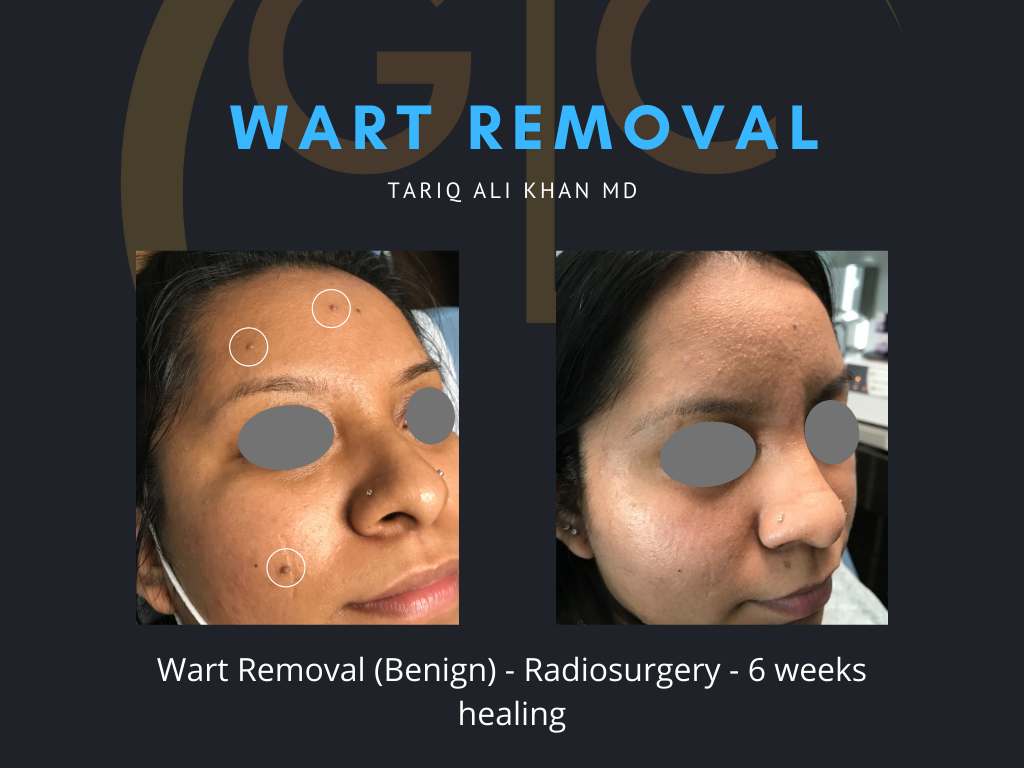 Gentle Care Laser Tustin & Long Beach Before and After picture - Wart Removal